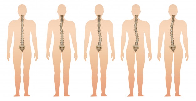 Home Screening for Scoliosis