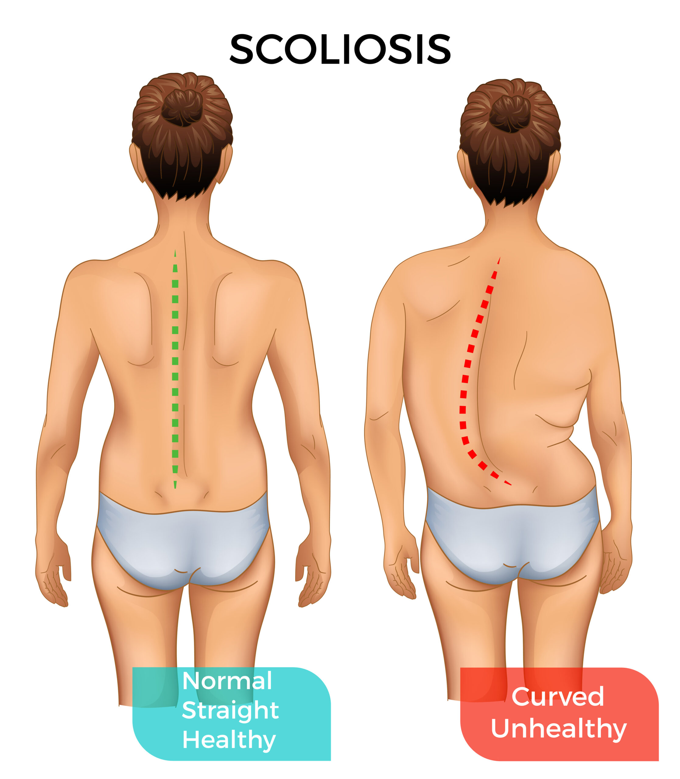 Home screening scoliosis