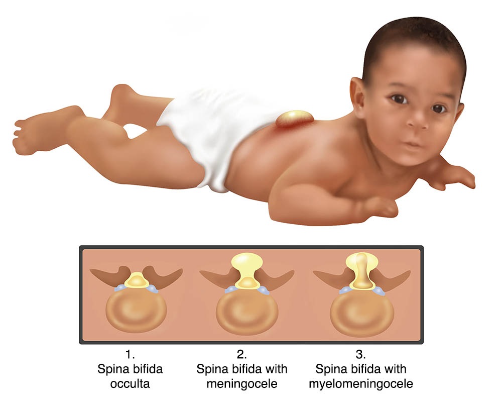 Spina bifida, its complications and types