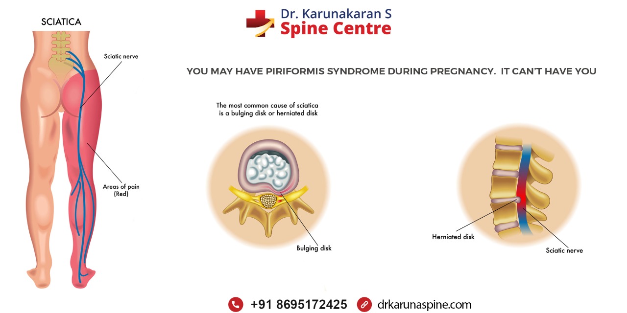 Piriformis syndrome and pregnancy