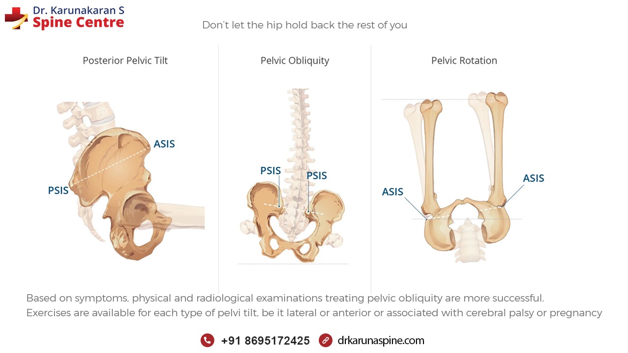 Treating pelvic obliquity and patterns Best Spine Specialist In