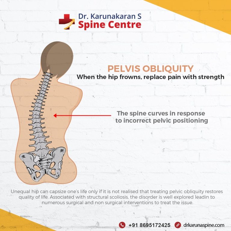 Treating pelvic obliquity and patterns Best Spine Specialist In
