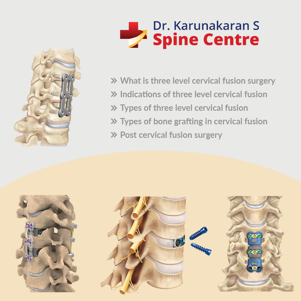 What is three level cervical fusion surgery?