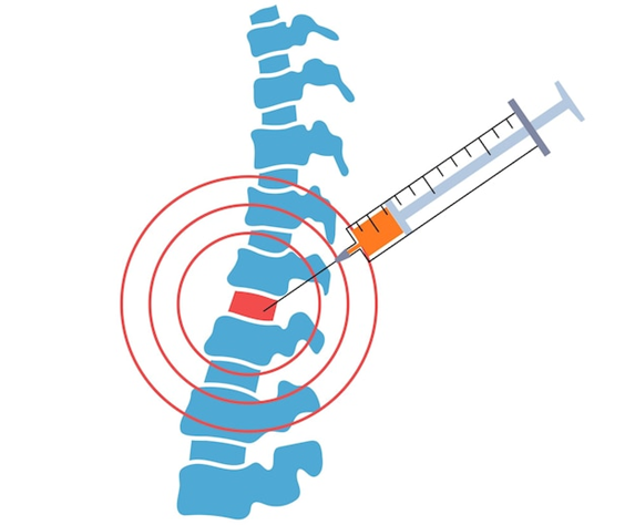 Epidural steroid injections