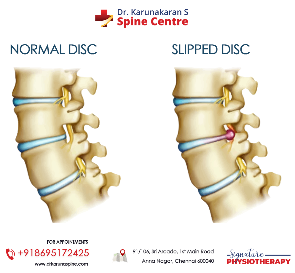 What’s a slipped disc?