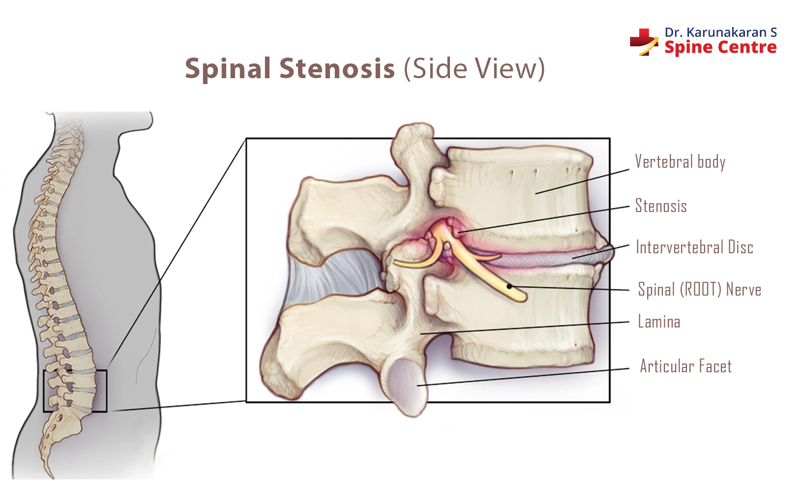 signs and symptoms of spinal stenosis