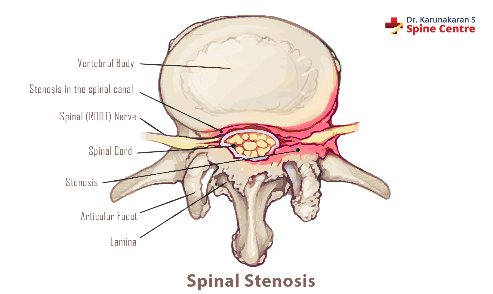 Symptoms of spinal stenosis
